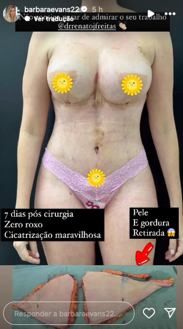 Bárbara mostra corpo após sete dias da cirurgia.(Imagem:Reprodução/Instagram)