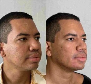 Ex-BBB Bruno Gaga faz harmonização facial de R$ 25 mil(Imagem:Reprodução)