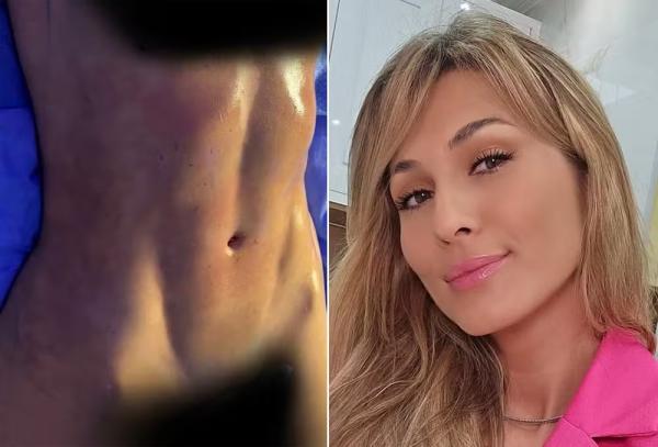 Lívia Andrade depois da lipo LAD.(Imagem:Reprodução/Instagram)