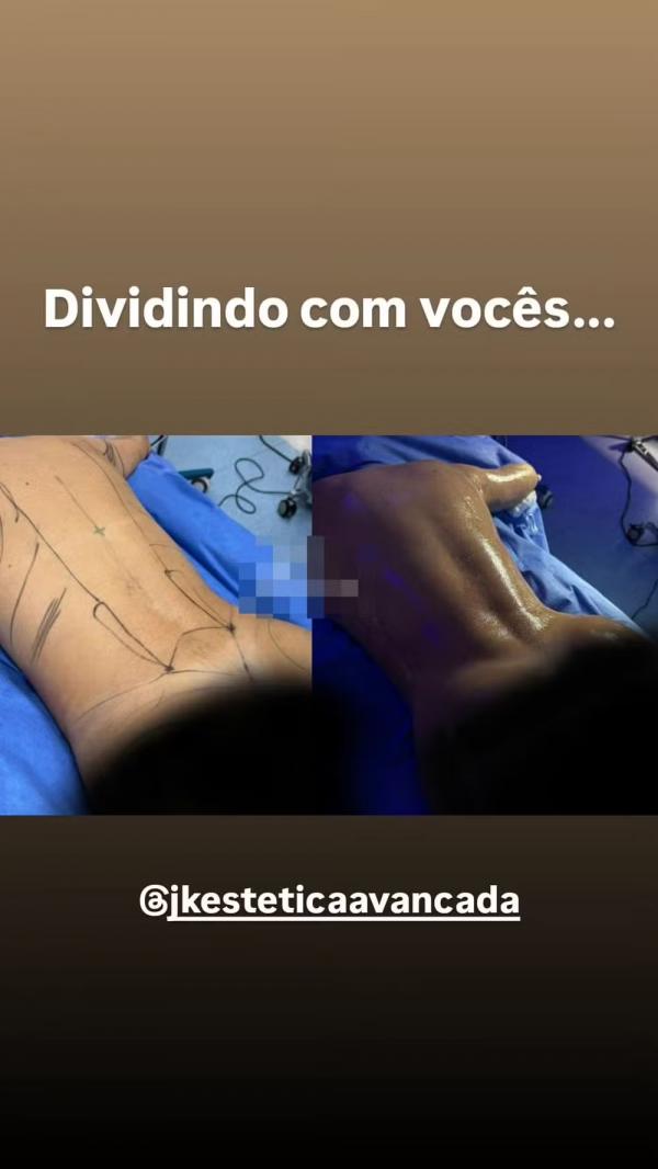 Antes e depois da lipo LAD de Lívia Andrade.(Imagem:Reprodução/Instagram)