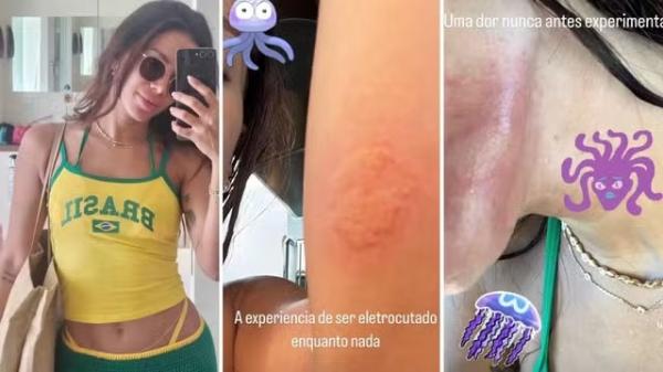 Anitta sofre queimadura por água-viva em Ibiza e relata maior dor da vida.(Imagem:Reprodução/Instagram)