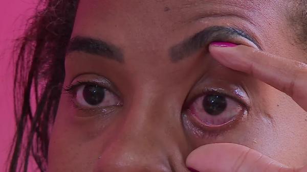 Ridja Dutra teve queimadura na retina ap&oacute;s usar pomada modeladora.(Imagem:Reprodu&ccedil;&atilde;o/TV Globo)