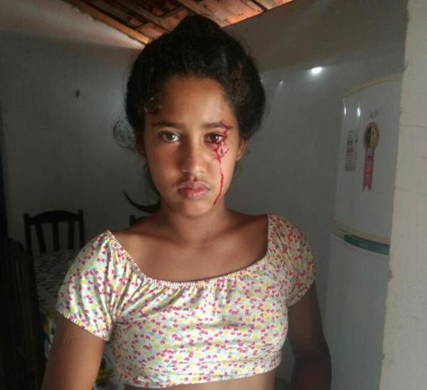 Menina de 12 anos sangra pelos olhos e família busca pelo diagnóstico no Piauí