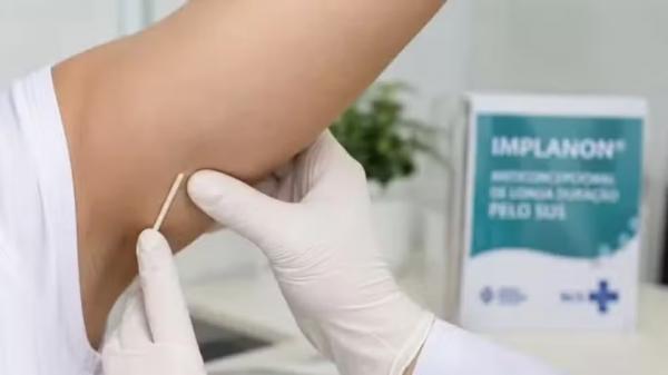 Oferta de "chip anticoncepcional" é ampliada para mais de 60 UBSs de Teresina; veja lista