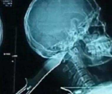 Homem leva facada na cabeça, mas consegue dirigir e pedir ajuda