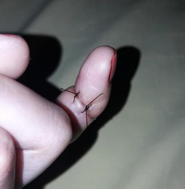 Jovem tem pescoço e dedo cortados por linha com cerol no Piauí