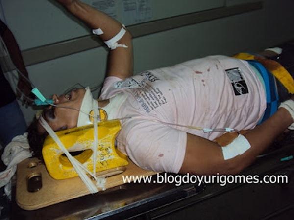 Colis&atilde;o de moto com trator deixa motoqueiro e garupeiro com fraturas expostas nas pernas.(Imagem:Blog do Yuri Gomes)