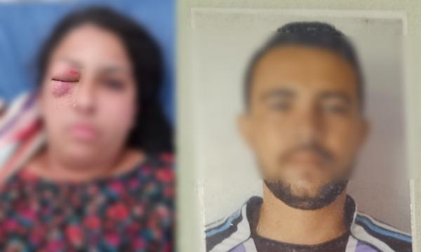 Mulher tem olho desfigurado ao ser agredia pelo companheiro em cidade do Piauí