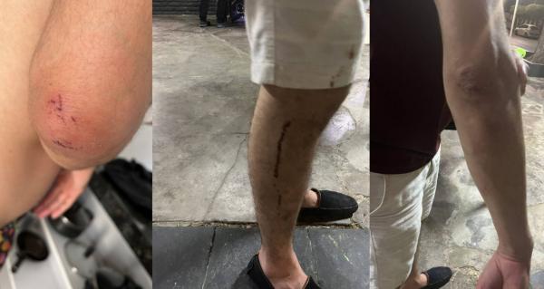 Casal denuncia estudante de medicina por agressão e homofobia em bar