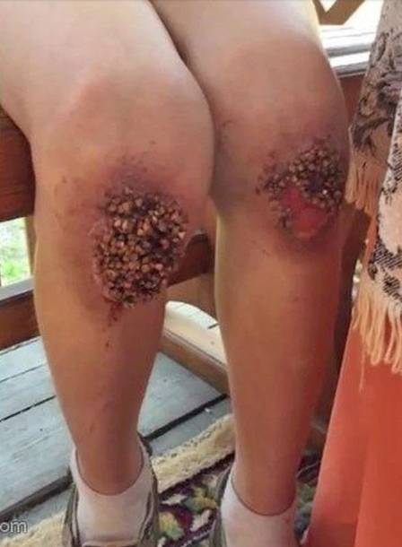 Mãe e padrasto obrigam menino se ajoelhar em grãos por até 9 horas