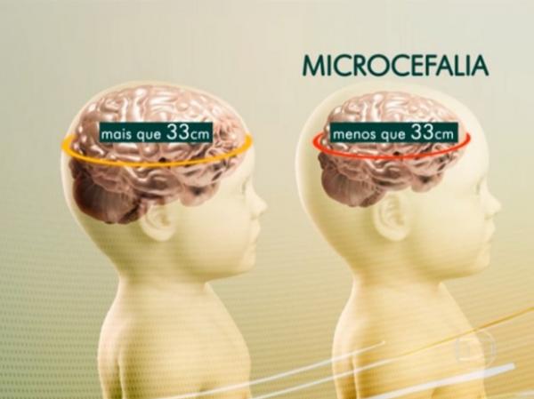 Anomalia &eacute; caracterizada por um cr&acirc;nio de tamanho menor que a m&eacute;dia.(Imagem:Tv Globo)