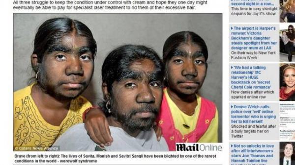As indianas t&ecirc;m a s&iacute;ndrome do lobisomem.(Imagem:Reprodu&ccedil;&atilde;o / Daily Mail  )