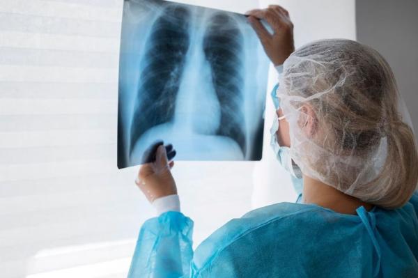Sesapi convoca municípios para fechamento de casos de tuberculose até o dia 30 de outubro