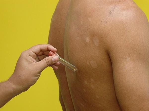 Casos de hanseníase em Teresina diminuem 50% em 10 anos, diz FMS