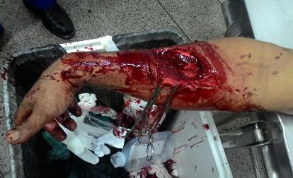 Homem é lesionado a faca durante briga em Floriano