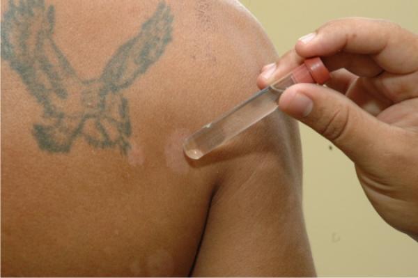 Piauí registra cerca de 100 casos de hanseníase em apenas dois meses