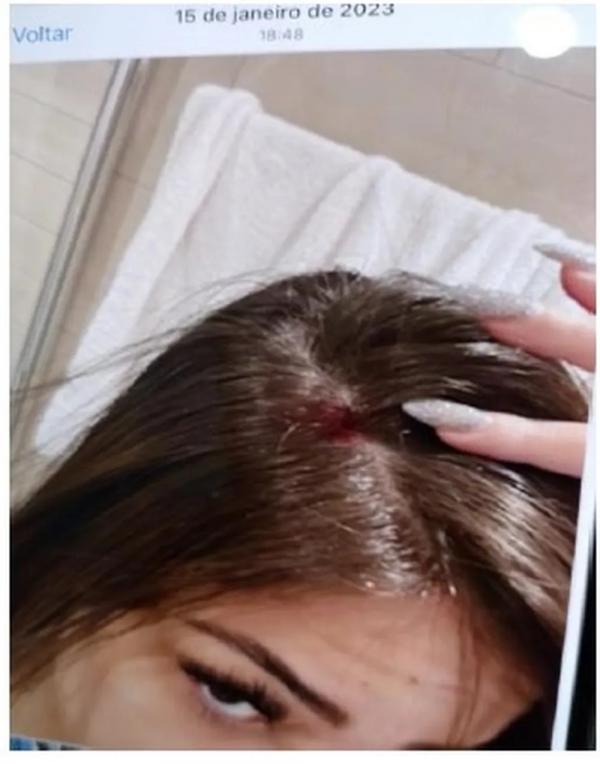 Gabriela Cavallin com ferimento na cabe&ccedil;a.(Imagem: Reprodu&ccedil;&atilde;o)