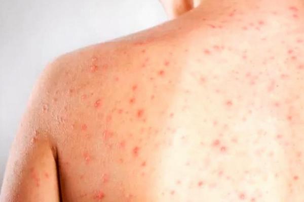 Médico alerta para os perigos do sarampo e a importância da vacina