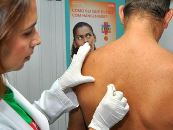 Casos de hanseníase diminuem 37% em 10 anos no Piauí, diz FMS