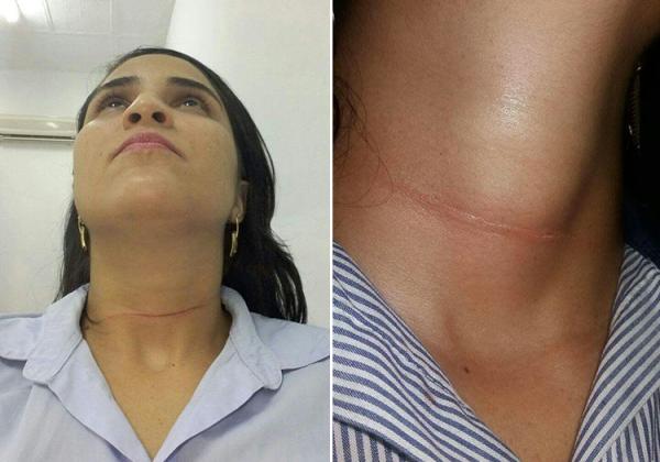 Mulher &eacute; v&iacute;tima de pipa com cerol.(Imagem:Divulga&ccedil;&atilde;o)