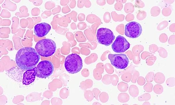Número de novos doadores de medula óssea cresce três vezes menos que a demanda no Brasil