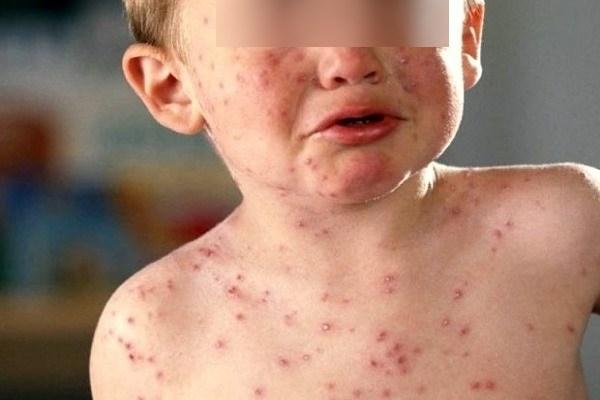 Sarampo: Roraima divulga sete casos suspeitos da doença