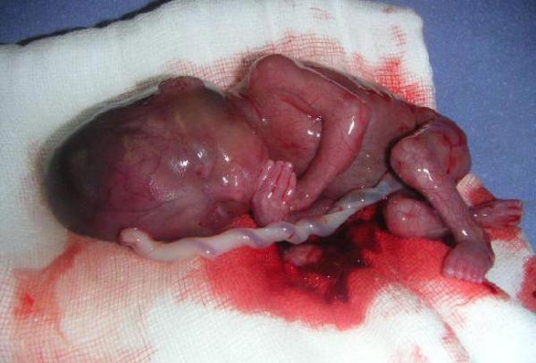 Projeto de lei prevê aumento de pena para aborto em caso de microcefalia