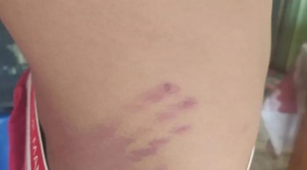  Adolescente de 13 anos ficou com marcas ap&oacute;s ser chicoteado no Piau&iacute;.(Imagem:Arquivo Pessoal )