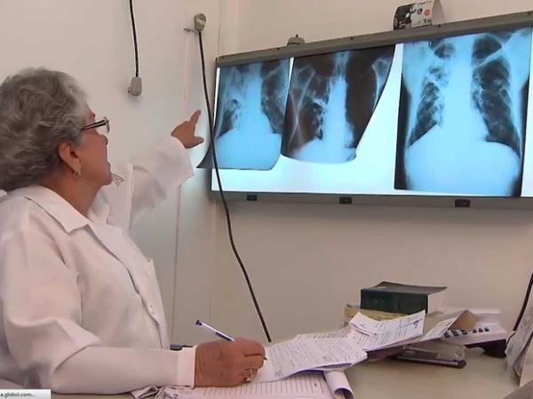 Tuberculose: Piauí registrou 2.595 casos nos últimos três anos