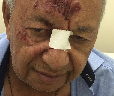Dr. Pessoa é atropelado por motocicleta e sofre lesões no rosto