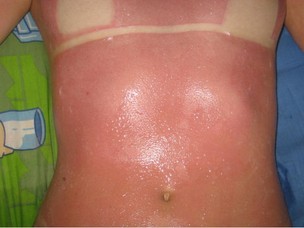Jovem denuncia clínica após queimaduras em bronzeamento