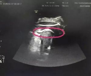 Com 35 semanas, chute de bebê fura útero da mãe