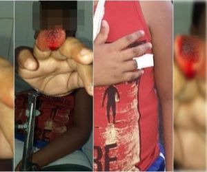 Criança tem dedo da mão decepado em escola no Piauí