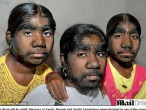 Irmãs indianas têm síndrome de lobisomen