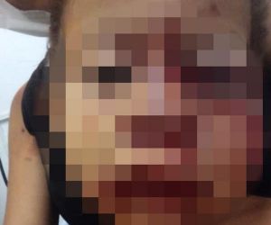 Menino de 2 anos tem rosto desfigurado após ataque de cachorro em São Julião, no Piauí
