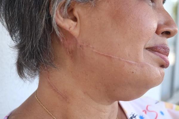  Marcas das agress&otilde;es sofridas por Guilhermina Ferreira.(Imagem:Lucas Marreiros /g1 )