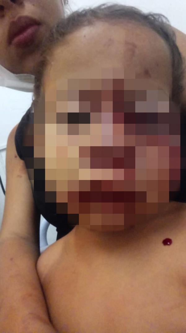 Menino de 2 anos tem rosto desfigurado ap&oacute;s ataque de cachorro em S&atilde;o Juli&atilde;o, no Piau&iacute;.(Imagem:Reprodu&ccedil;&atilde;o)