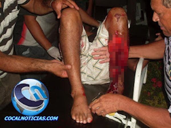 Colis&atilde;o de moto com trator deixa motoqueiro e garupeiro com fraturas expostas nas pernas.(Imagem:Blog Cocal Not&iacute;cias )