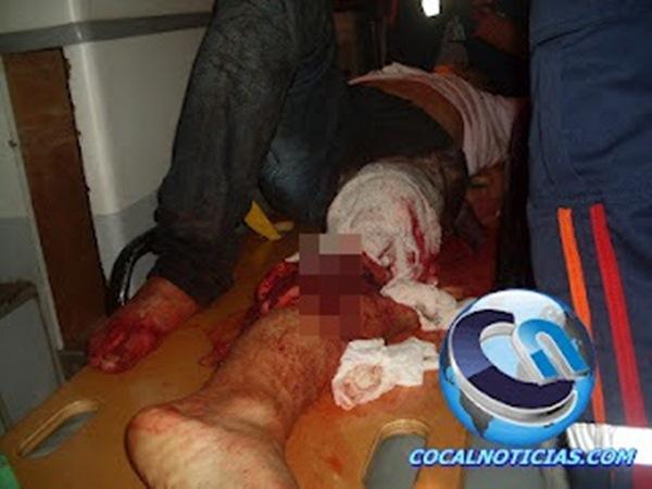 Colis&atilde;o de moto com trator deixa motoqueiro e garupeiro com fraturas expostas nas pernas.(Imagem:Blog Cocal Not&iacute;cias)