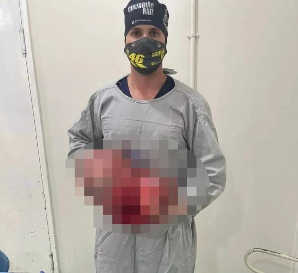 Médicos retiram tumores pesando quase 11 kg de paciente idosa em Floriano